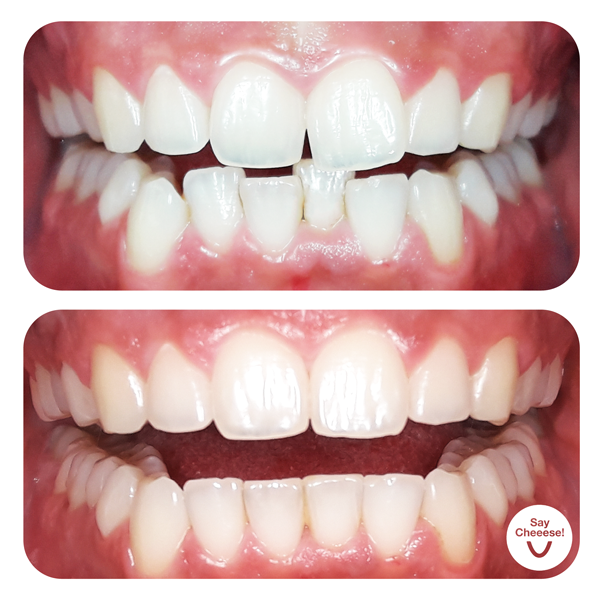 Lücke & Engstand · Vorher / Nachher