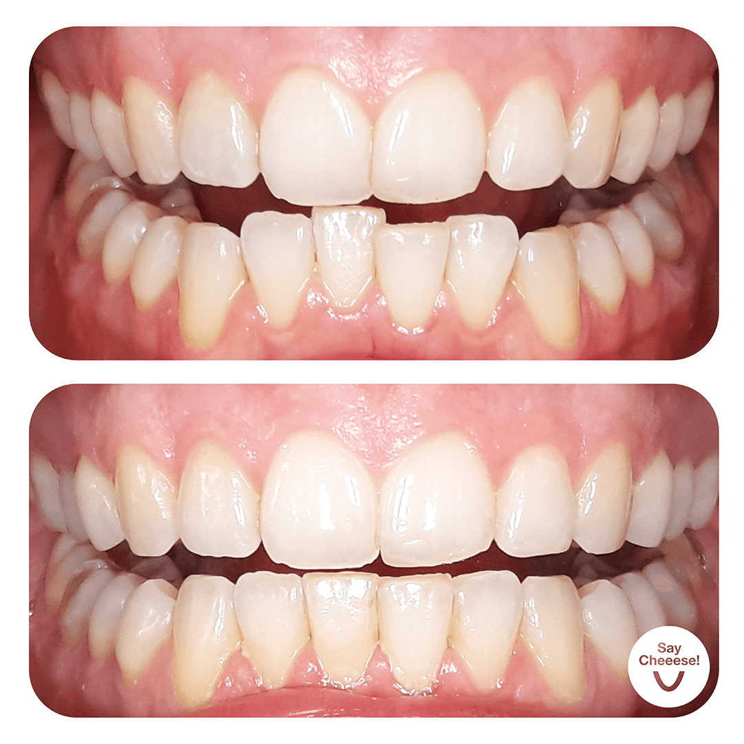 Engstand · Vorher / Nachher