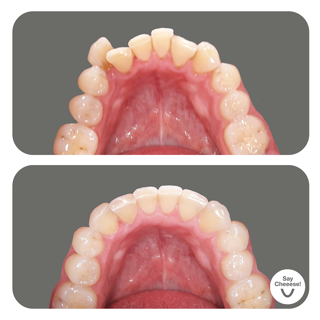 Engstand · Vorher / Nachher